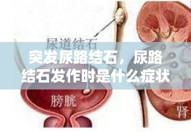 突發(fā)尿路結(jié)石，尿路結(jié)石發(fā)作時是什么癥狀? 